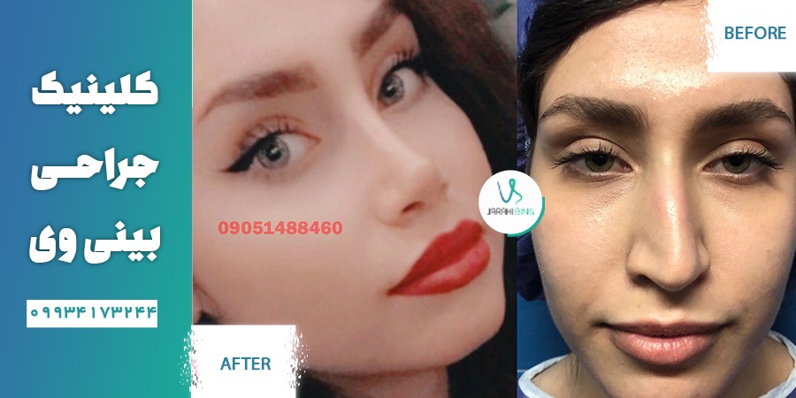 انواع عمل جراحی بینی