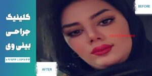 مراقبت های بعد از جراحی بینی