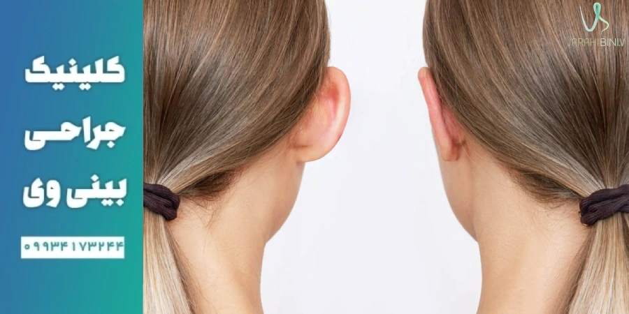 مزایای عمل اتوپلاستی