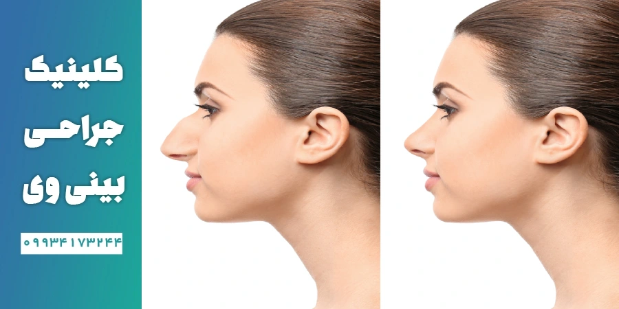 رفع قوز بینی با جراحی