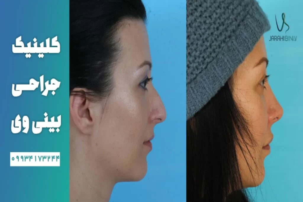 روش های اصلاح و رفع قوز بینی
