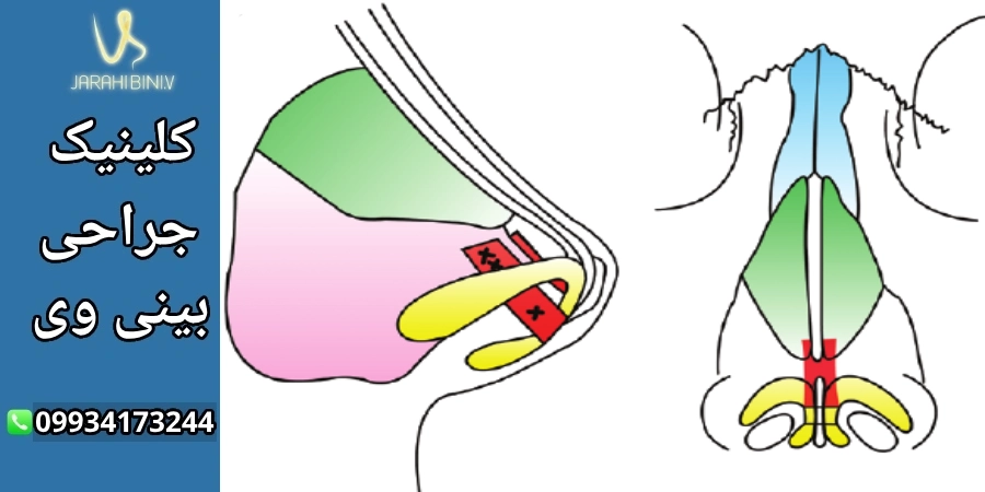 گرافت بینی- دکتر آرزو خوانساری نیا
