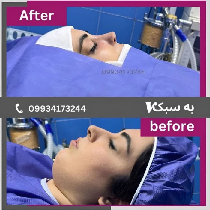 نتایج عمل بینی استخوانی - دکتر آرزو خوانساری‌نیا