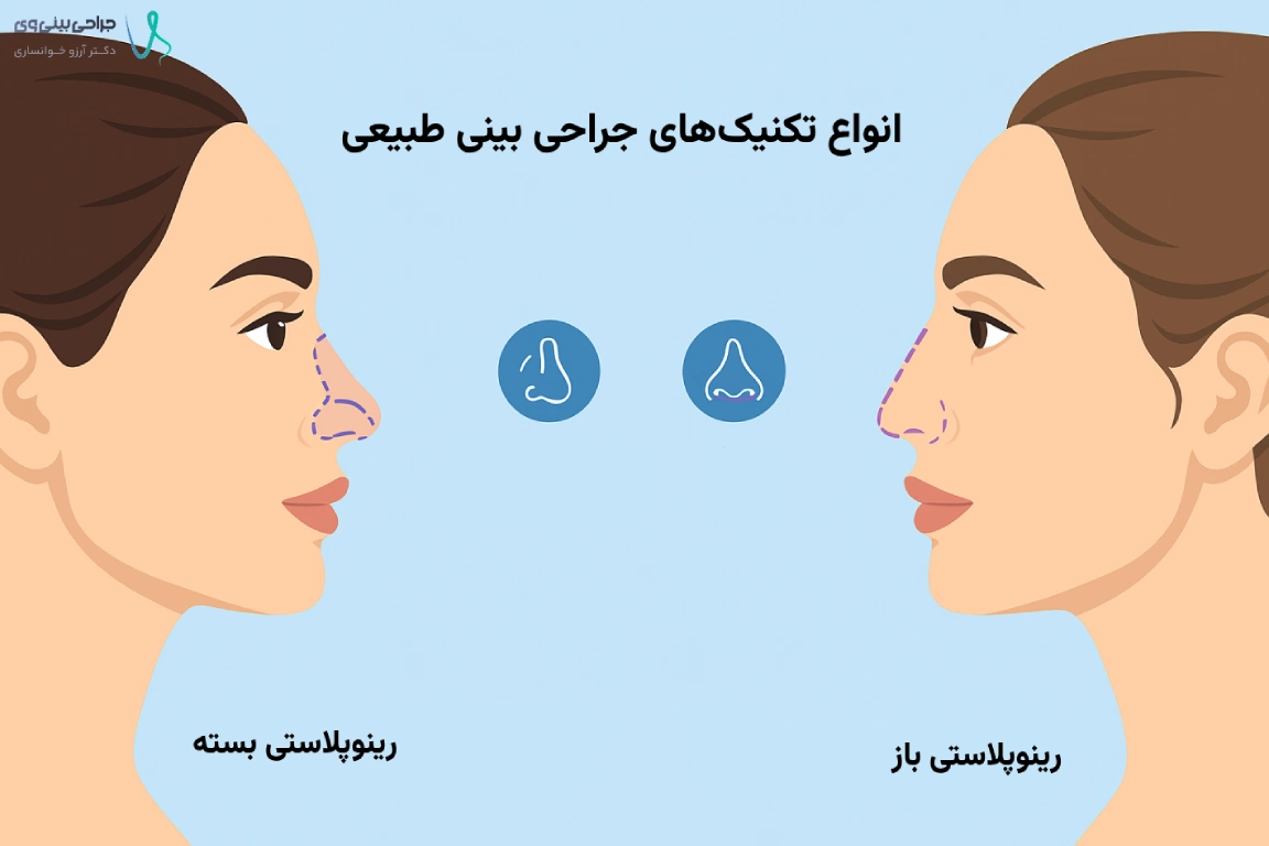 انواع تکنیک‌های جراحی بینی طبیعی شامل روش‌های مختلف رینوپلاستی