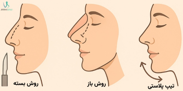 روشهای مختلف جراحی بینی توسط بهترین جراح بینی خانم در تهران