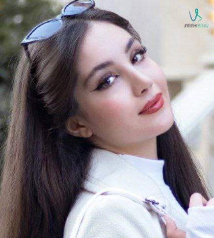 مدل بینی زنانه زیبا و طبیعی در تهران