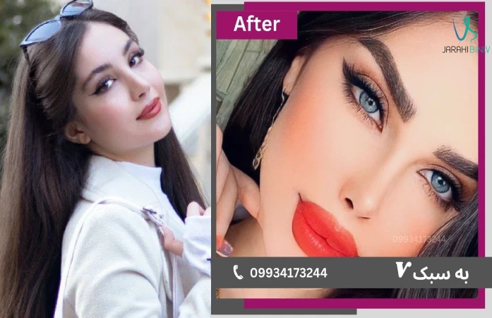 نمونه جراحی بینی طبیعی توسط بهترین جراح بینی خانم در تهران