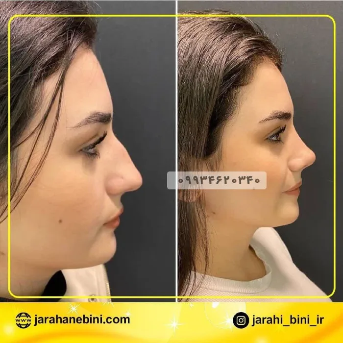 نمونه جراحی بینی نیمه‌فانتزی ۵ – دکتر اکبر اعتمادی
