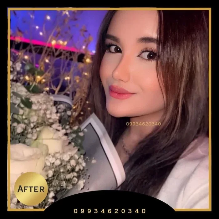 نمونه جراحی بینی نیمه‌فانتزی ۶ – دکتر اکبر اعتمادی