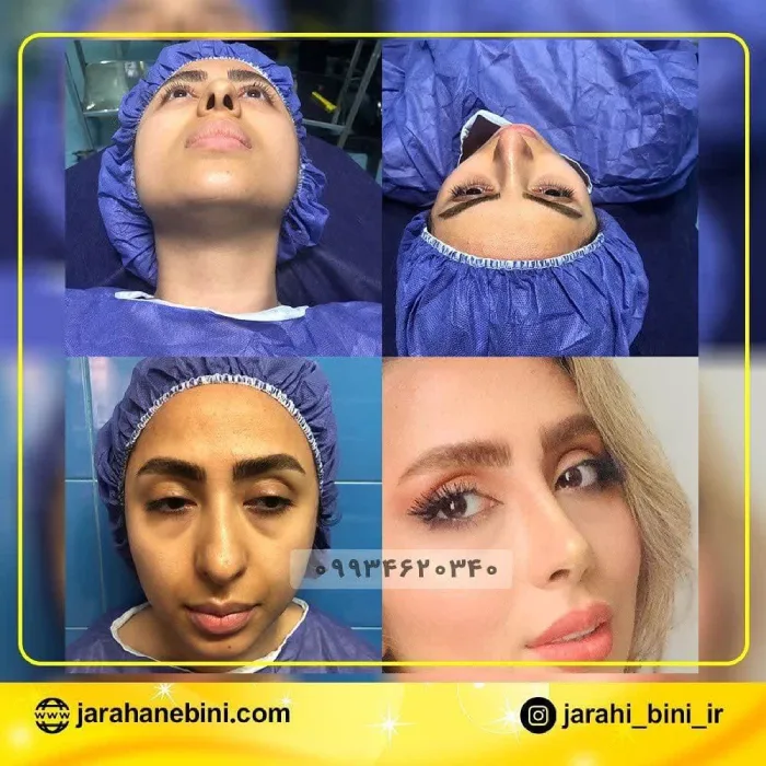 تصاویر جراحی بینی استخوانی - دکتر اکبر اعتمادی