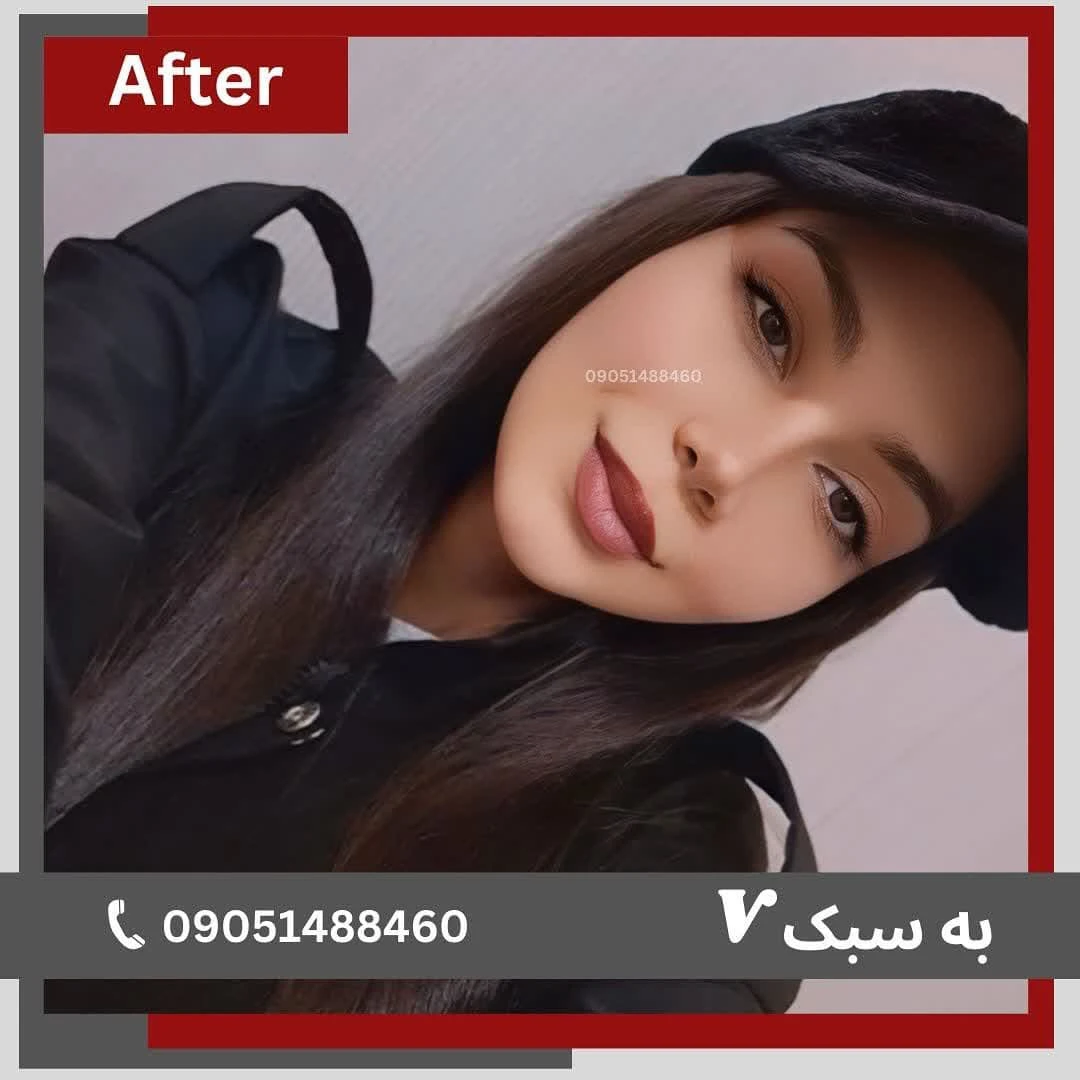 نمونه جراحی بینی دکتر خسرو مقتدر 1