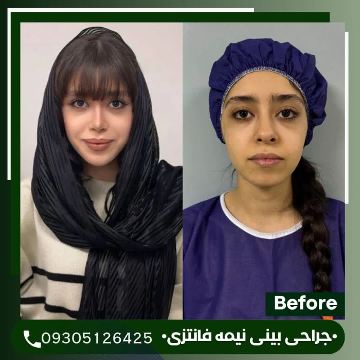 اصلاح قوز و تقویت غضروف در جراحی بینی گوشتی | دکتر علی شکرریز