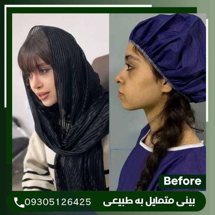 نتیجه پایدار جراحی بینی گوشتی | دکتر علی شکرریز