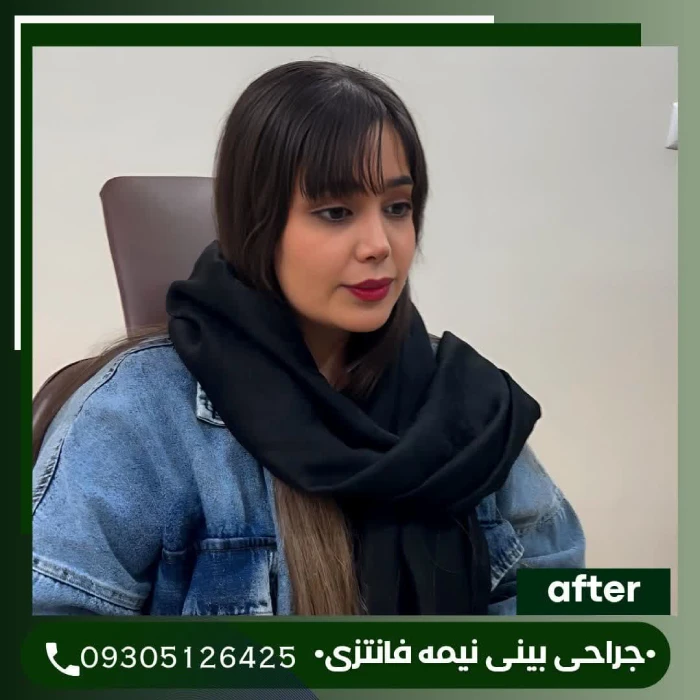 نمونه جراحی بینی گوشتی با فرم طبیعی | دکتر علی شکرریز