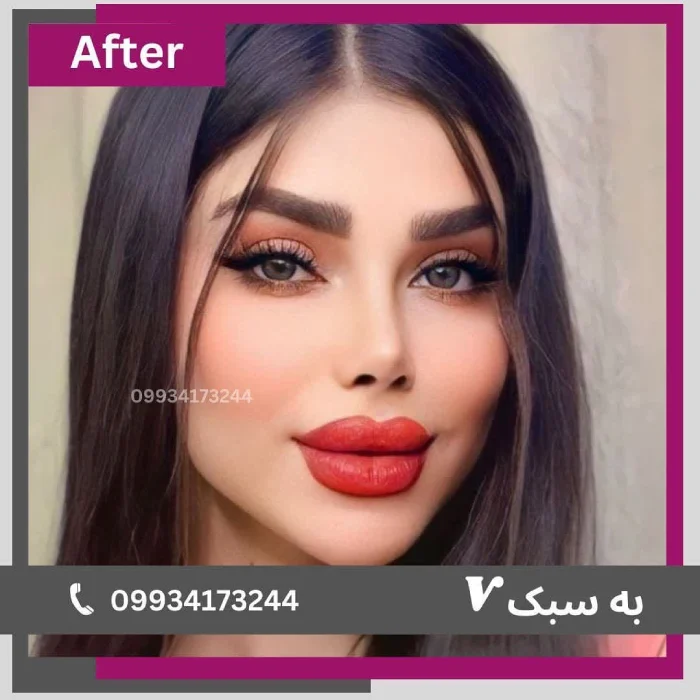 نمونه‌کار ۶ بعد از جراحی بینی – نمای نیم‌رخ