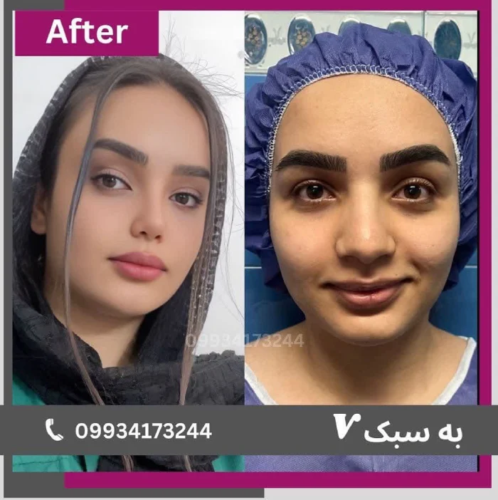 نمونه‌کار ۵ بعد از جراحی بینی – نمای سه‌ربع