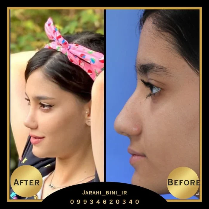 نمونه جراحی بینی دکتر اکبر اعتمادی 10