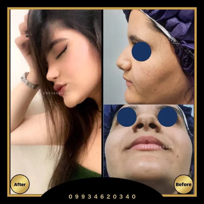 نمونه جراحی بینی دکتر اکبر اعتمادی 9