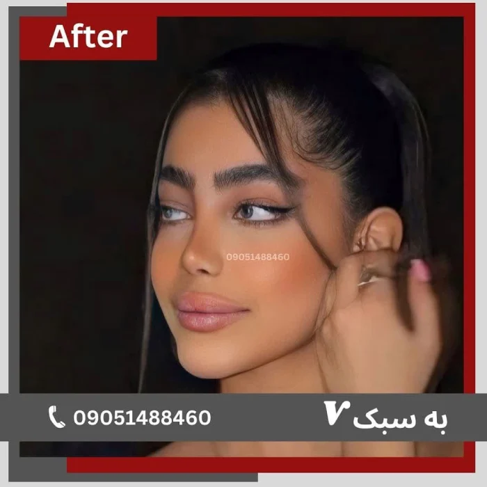 Before/After جراحی بینی گوشتی و ترمیمی در تهران | دکتر خسرو مقتدر