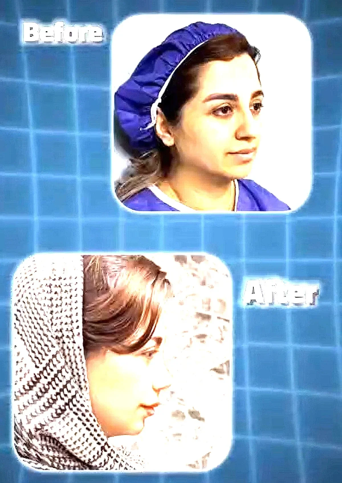 قوس فانتزی + تقویت غضروف | نمونه ۲