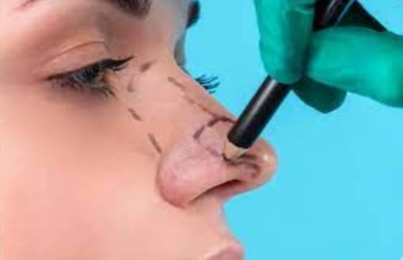 جراحی بینی گوشتی زنانه در تهران؛ فرم طبیعی و هماهنگ با صورت