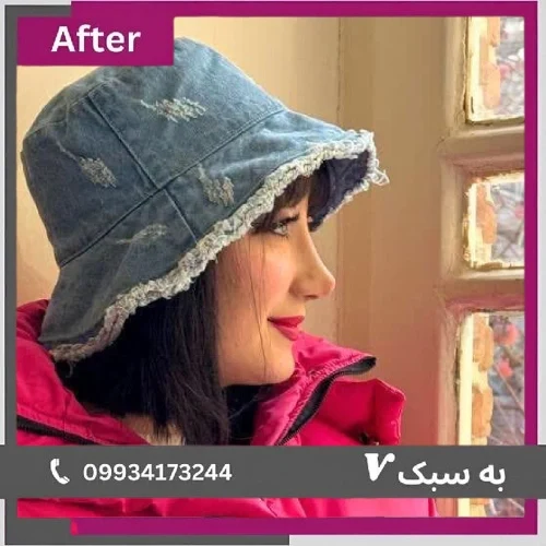 نمونه جراحی بینی ترمیمی با اصلاح فرم و بهبود تقارن