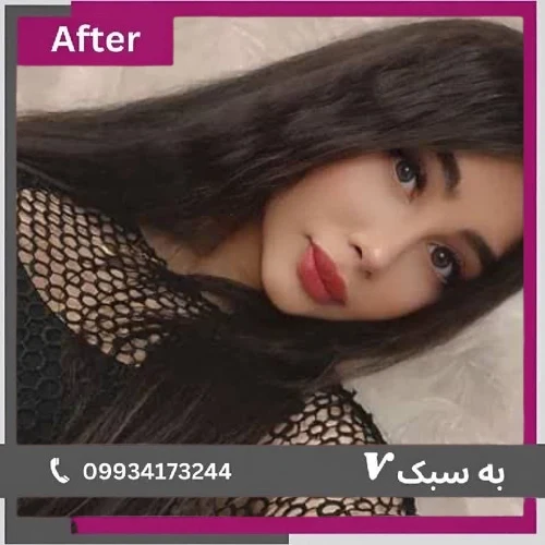 نمونه جراحی بینی طبیعی؛ معرفی بهترین جراح بینی طبیعی در تهران