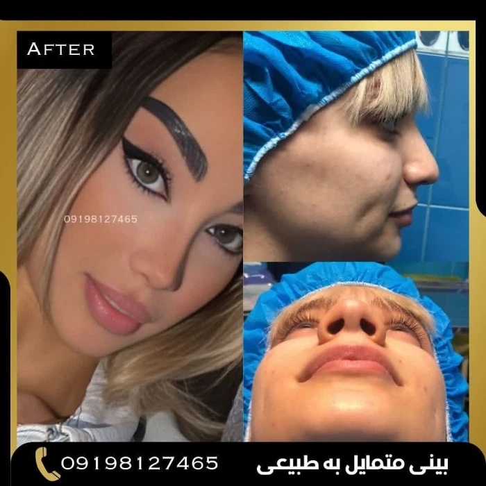 نمونه عمل بینی دکتر امین بختیاری 11