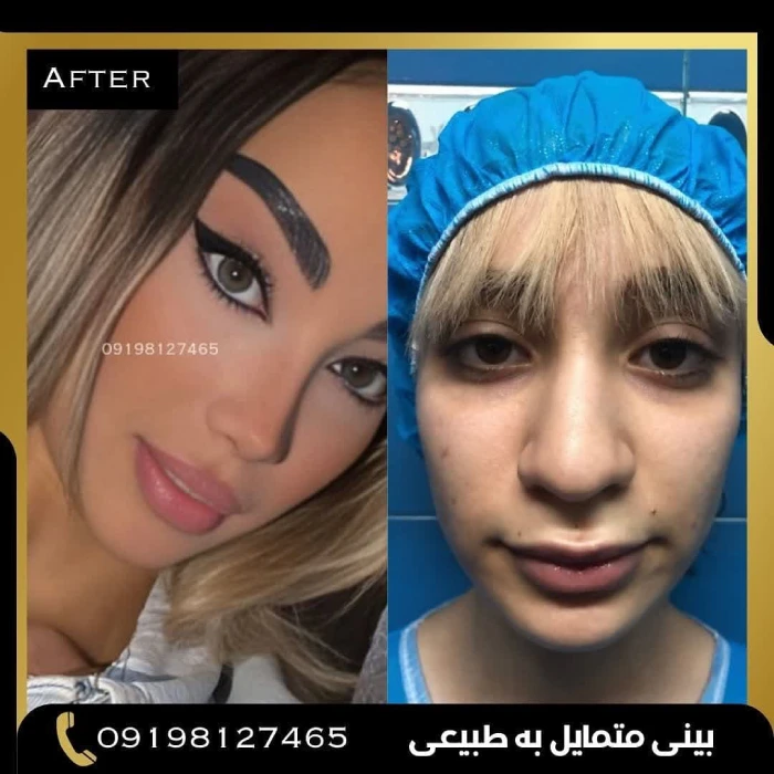 نمونه جراحی بینی نیمه‌فانتزی ۶ – دکتر امین بختیاری | بهترین جراح بینی نیمه فانتزی در تهران
