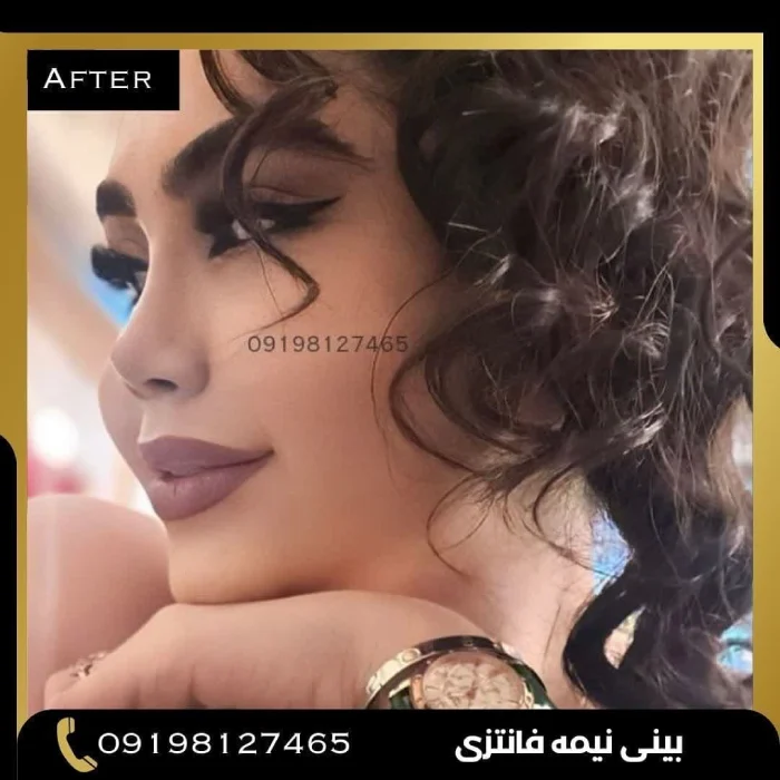 تصویر یکی از نتایج جراحی بینی دکتر امین بختیاری از نمای قبل و بعد