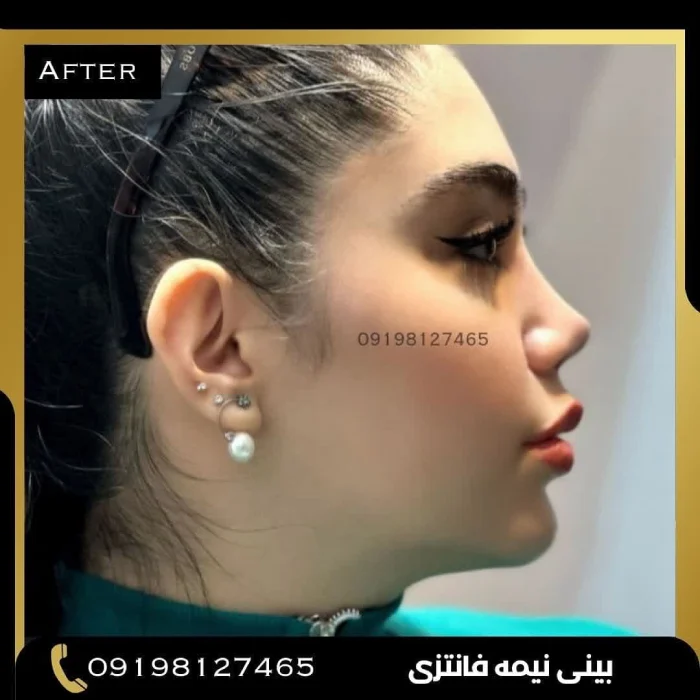 نمونه عمل بینی دکتر امین بختیاری 3