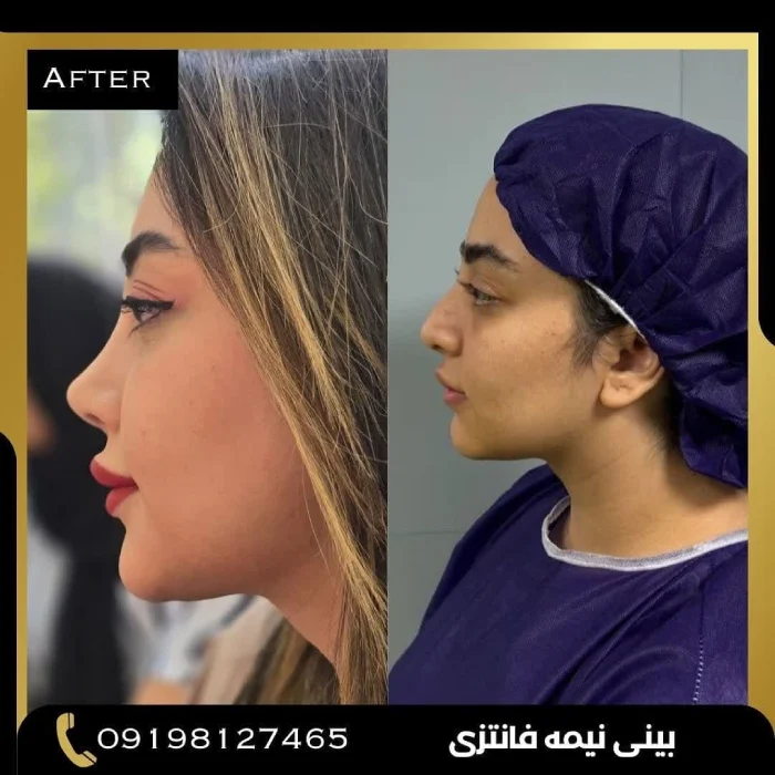 نتیجه طبیعی و متناسب بعد از جراحی بینی گوشتی | دکتر امین بختیاری