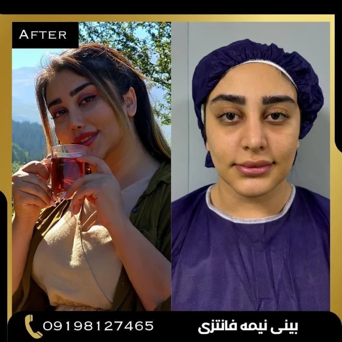 قبل و بعد جراحی بینی استخوانی با نتیجه طبیعی – دکتر امین بختیاری