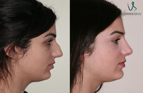 نمونه جراحی بینی نیمه‌فانتزی ۶ – دکتر علی شکرریز