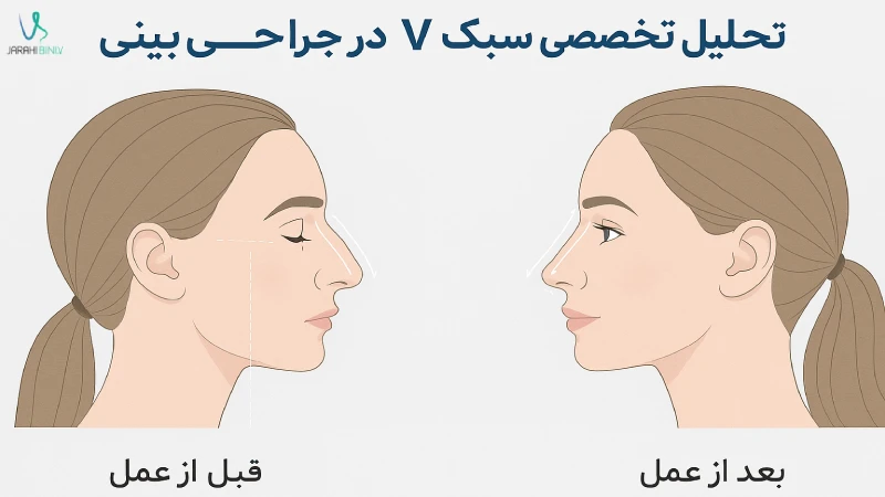 تحلیل تخصصی سبک V در جراحی بینی توسط دکتر آرزو خوانساری‌نیا