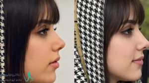 عکس قبل و بعد جراحی بینی