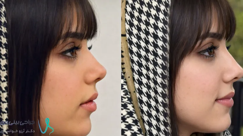 عکس قبل و بعد جراحی بینی