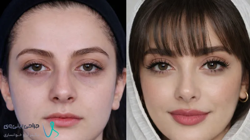 عکس قبل و بعد جراحی بینی
