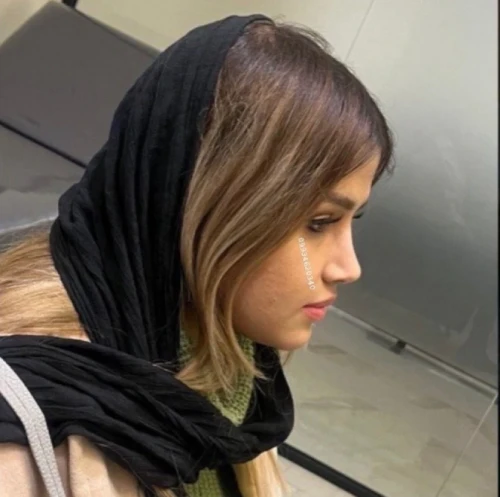 نتیجه نهایی جراحی بینی گوشتی با فرم زیبا و طبیعی توسط دکتر اکبر اعتمادی