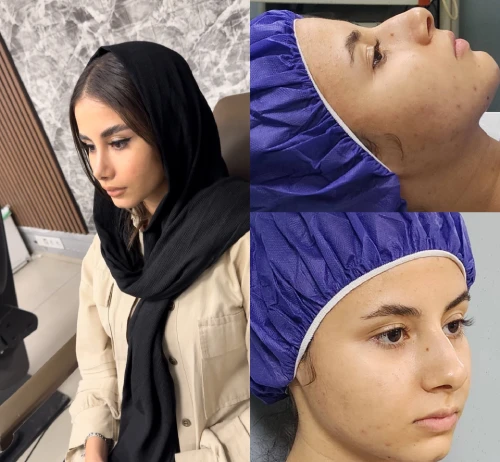 نمونه جراحی بینی استخوانی با فرم طبیعی و متقارن – دکتر آرزو خوانساری‌نیا