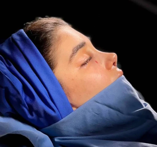 نمای قبل و بعد بینی گوشتی، تغییر فرم و شکل طبیعی