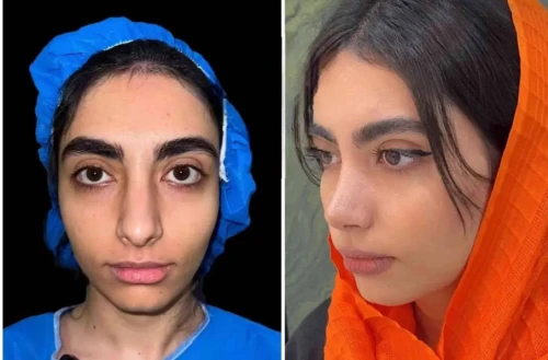 نتیجه جراحی بینی استخوانی از نمای تمام‌رخ – دکتر آرزو خوانساری‌نیا