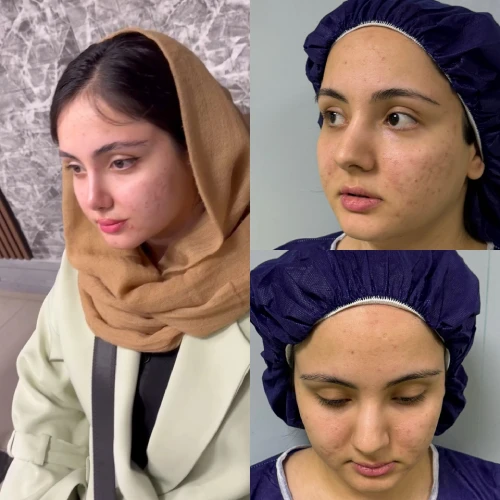 نمای نیم‌رخ بینی بعد از جراحی با حفظ تقارن و فرم طبیعی