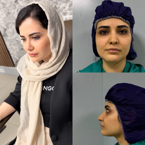نمای روبه‌رو بینی بعد از جراحی، فرم طبیعی و متناسب با چهره بیمار