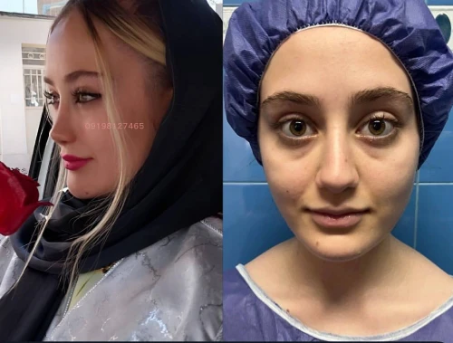 نمای روبه‌رو بینی گوشتی پس از جراحی با فرم طبیعی و متناسب با چهره