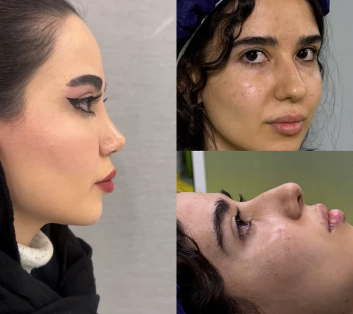 نمای نیم‌رخ بینی گوشتی بعد از عمل دکتر اکبر اعتمادی با حفظ تقارن صورت