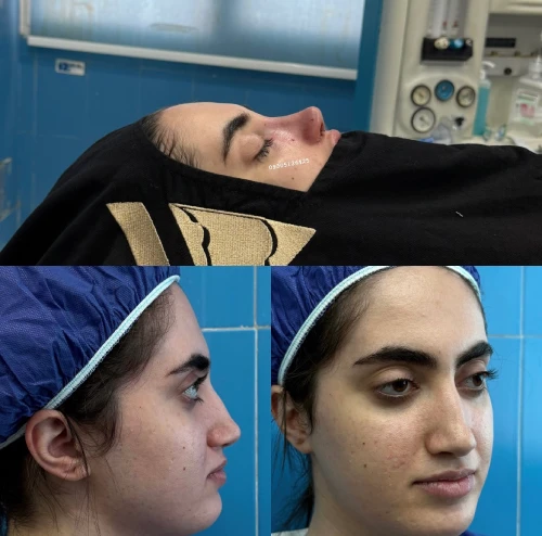نمونه عمل بینی با فرم متناسب با چهره توسط دکتر علی شکرریز
