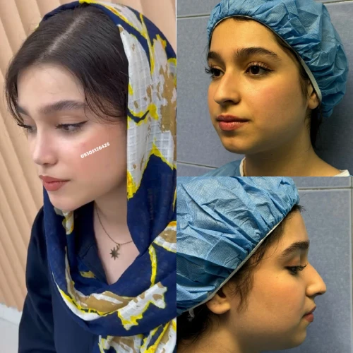 نمونه کار جراحی بینی دکتر علی شکرریز در تهران