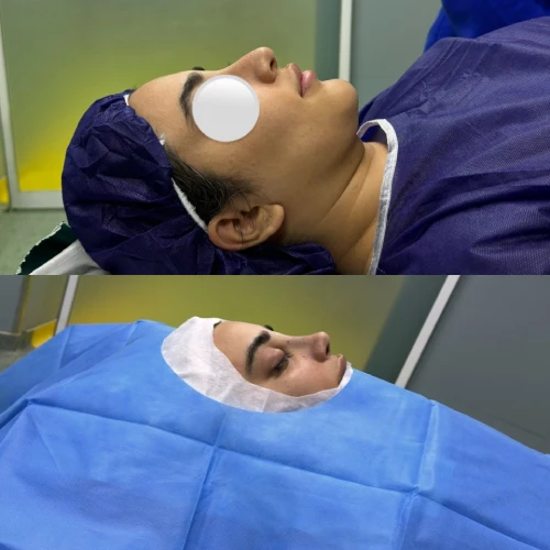 تصاویر قبل و بعد جراحی بینی استخوانی - دکتر علی شکرریز
