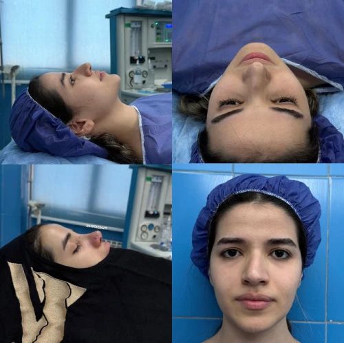 گالری نمونه کار جراحی بینی دکتر علی شکرریز